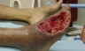 Krokodil: la droga de la calle que come la carne de adentro hacia afuera [FOTOS]