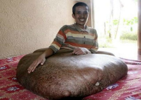 El hombre con el tumor más grande del mundo (Video)