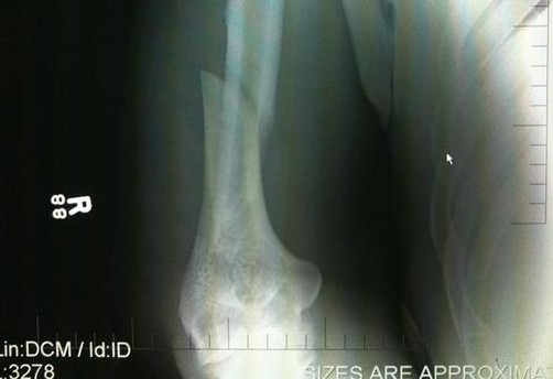 Rodrigo Minotauro quedó con el brazo roto en el UFC 140