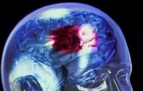 Condición cardíaca infratratada que incrementa el riesgo de enfermedades cerebro-vasculares une a médicos y pacientes