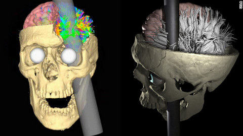 Phineas Gage vivió 12 años con una varilla en el cerebro