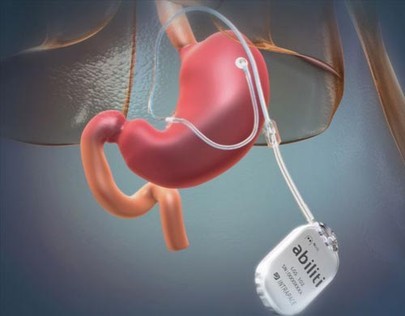 España: Mujer colombiana pierde 25 kilos tras recibir primer marcapasos gástrico