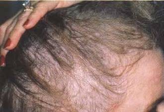 Caída del cabello es señal de preocupaciones