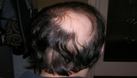 ¿Sabes qué es la alopecia?