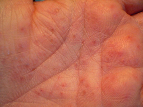 Dermatitis de contacto afecta más a las amas de casa, trabajadores de construcción y de salud
