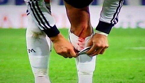 Cristiano Ronaldo sufre un terrible corte en la pierna [FOTO]