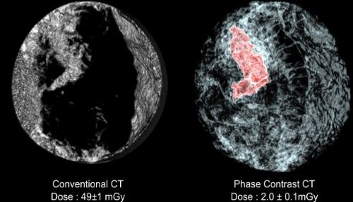 Nuevos escáneres 3D para detectar cáncer de mama