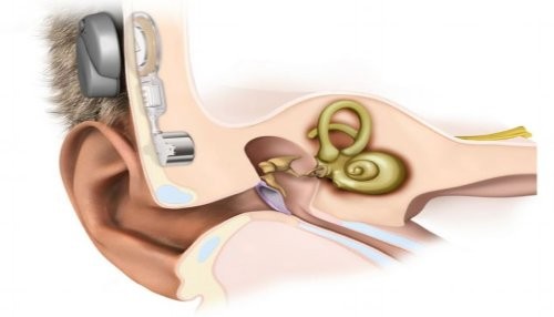 Implante pionero podría restablecer la audición a miles