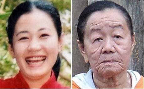Vietnam: Una rara enfermedad hace que una mujer envejezca a los 23 años