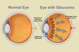 Glaucoma ya puede Detectarse Tempranamente