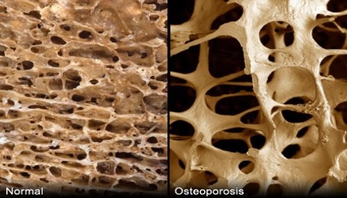 Osteoporosis no diagnosticadas a tiempo desencadenan fracturas en jóvenes y adultos