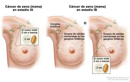 Agendia Informa Más De 20.000 Resultados De Su Prueba Mammaprint De Cáncer De Mama Recurrente