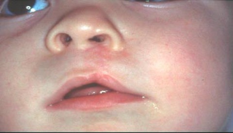 Hospital San Bartolomé inicia campaña para operar a niños con labio leporino