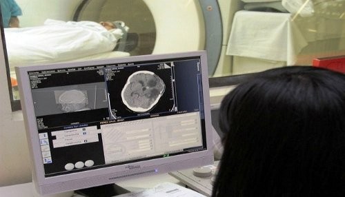 Identifique a tiempo las señales de un ataque cerebrovascular