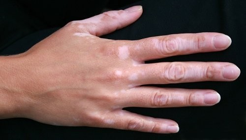 Se tratan males como vitiligo, psoriasis, dermatitis, urticaria y cuadros alérgicos