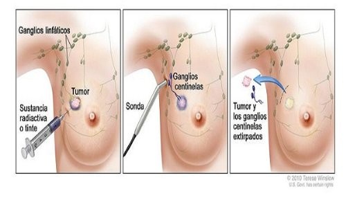 EsSalud utiliza novedosa técnica para cirugía en cáncer de mama