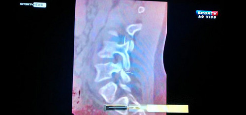 Radiografía de Neymar que muestra la lesión en la tercera vertebra lumbar: Televisión brasilera la dio a conocer