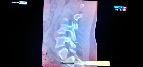 Radiografía de Neymar que muestra la lesión en la tercera vertebra lumbar: Televisión brasilera la dio a conocer