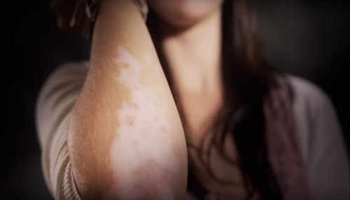 Psoriasis impacta más en las mujeres