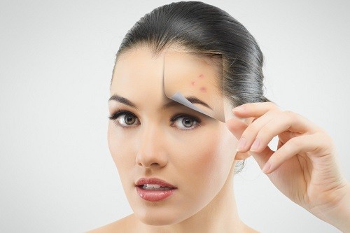 Las 6 zonas más frecuentes del acné