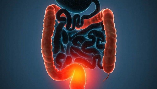 ¿Conoces la enfermedad inflamatoria intestinal?