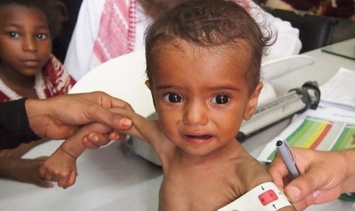 85,000 niños pequeños murieron de hambre en la guerra civil de Yemen