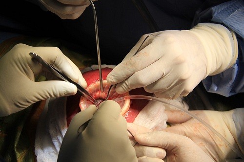 Incrementan cirugías fetales para salvar a bebés con complicaciones