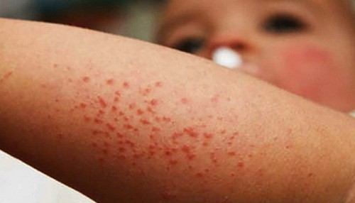 Número de casos de sarampión sigue aumentando en Washington en medio de un brote
