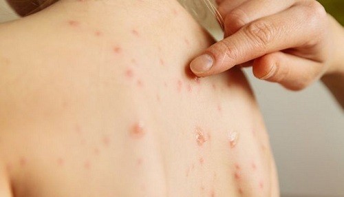 Informe muestra que los casos de sarampión están aumentando en los Estados Unidos