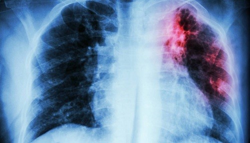 Fibrosis pulmonar idiopática es más frecuente en adultos a partir de los 50 años de edad