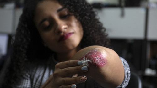 Cinco consejos para elevar la calidad de vida de pacientes con psoriasis