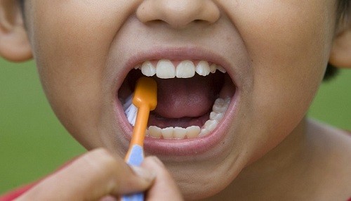 Establecimientos de salud brindarán diagnóstico y tratamiento contra la maloclusión dental infantil