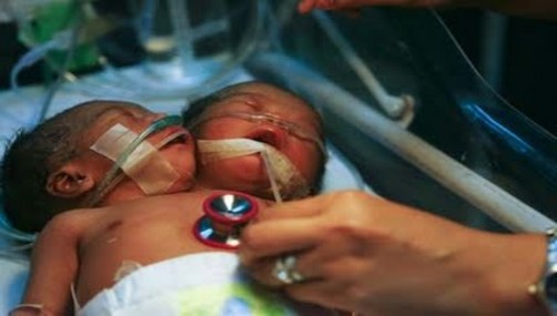 China: Consternación por nacimiento de bebé con dos cabezas