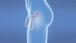 La circuncisión podría evitar que los hombres padezcan de cáncer de próstata