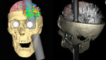 Phineas Gage vivió 12 años con una varilla en el cerebro