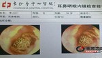 China: Araña vivió 5 días dentro del oído de una mujer
