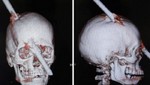 Hombre sobrevive tras atravesarle una barra de acero en el cráneo por accidente