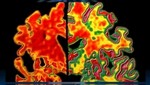 Prueba de Alzheimer detecta la enfermedad con décadas de anticipación