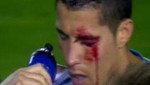Cristiano Ronaldo sufre la rotura de su ceja ante el Levante [VIDEO]