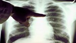 Píldora para cáncer de pulmón es una nueva esperanza para los enfermos