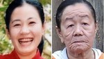 Vietnam: Una rara enfermedad hace que una mujer envejezca a los 23 años