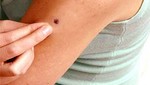Más de 4,000 casos de cáncer de piel se registran cada año en el Perú