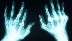 Nuevas pistas genéticas para la cura de la artritis reumatoide