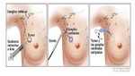 EsSalud utiliza novedosa técnica para cirugía en cáncer de mama