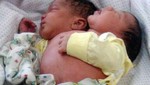 Brasil: Nace bebé siamés con dos cabezas