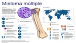 Mieloma múltiple: un cáncer más frecuente a partir de los 60 años