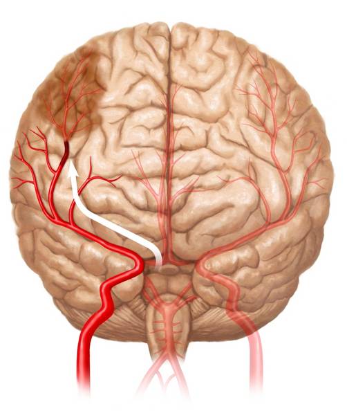 Estudio demuestra reducción del riesgo de desarrollar un Accidente Cerebro Vascular (ACV)