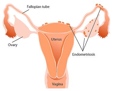 Sanidad retira un fármaco para la endometriosis