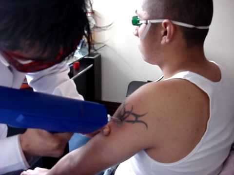 Borrar tatuajes Eliminar tatuajes Quitar tatuajes Borrado de tatuajes en Lima Perú