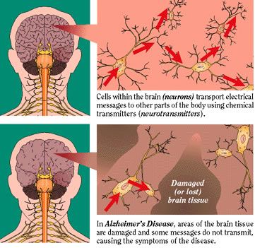 Contra el alzheimer: Neuróbica 'Gimnasia para el cerebro'